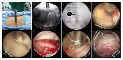 Therapeutic Effect of Large Channel Endoscopic Decompression in Lumbar Spinal Stenosis